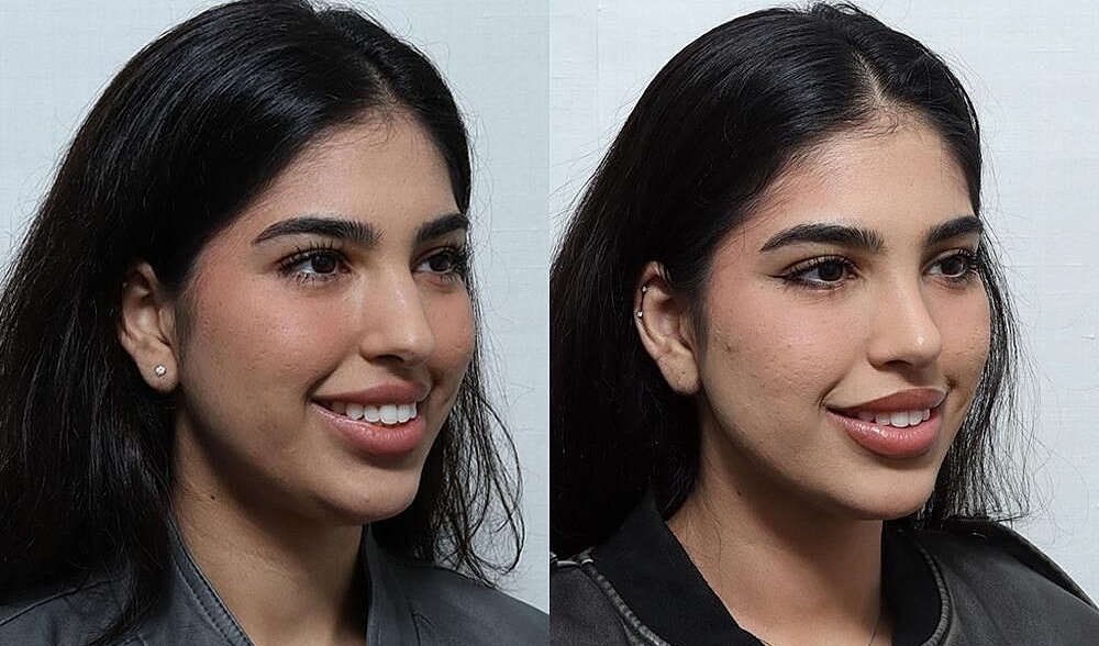 Rhinoplasty Before & After