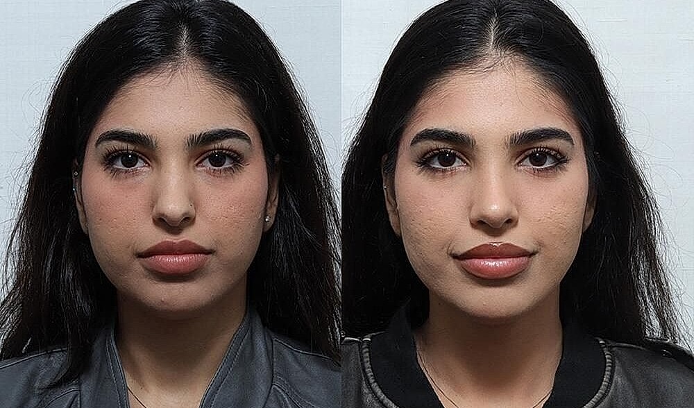 Rhinoplasty Before & After