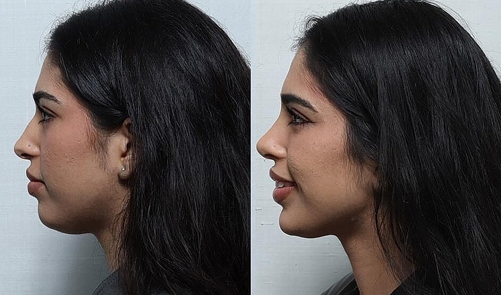 Rhinoplasty Before & After
