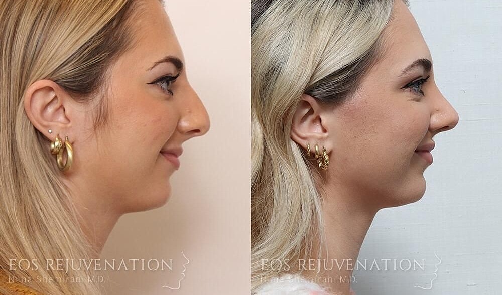 Rhinoplasty Before & After