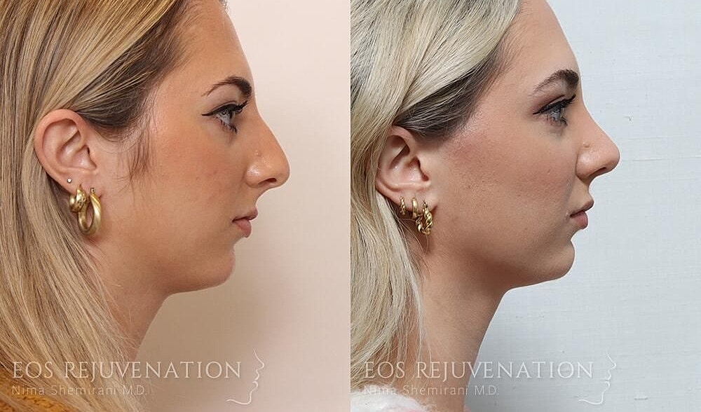 Rhinoplasty Before & After