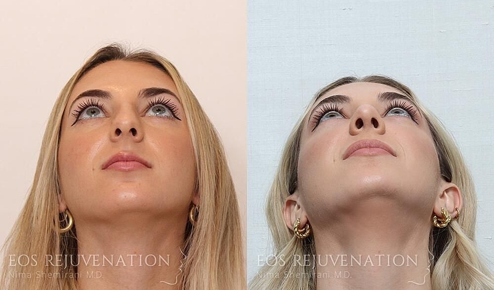 Rhinoplasty Before & After