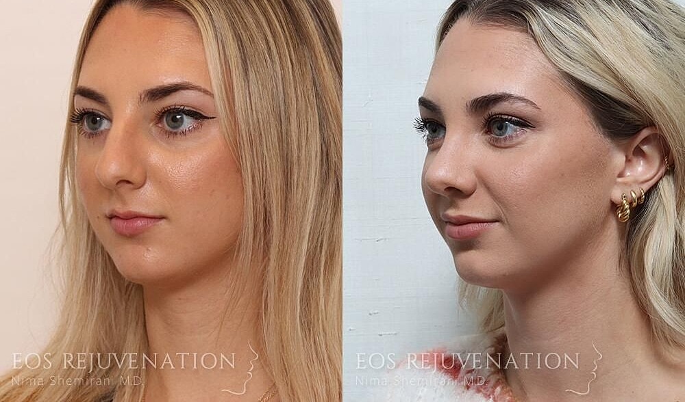 Rhinoplasty Before & After