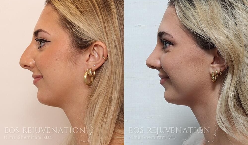 Rhinoplasty Before & After
