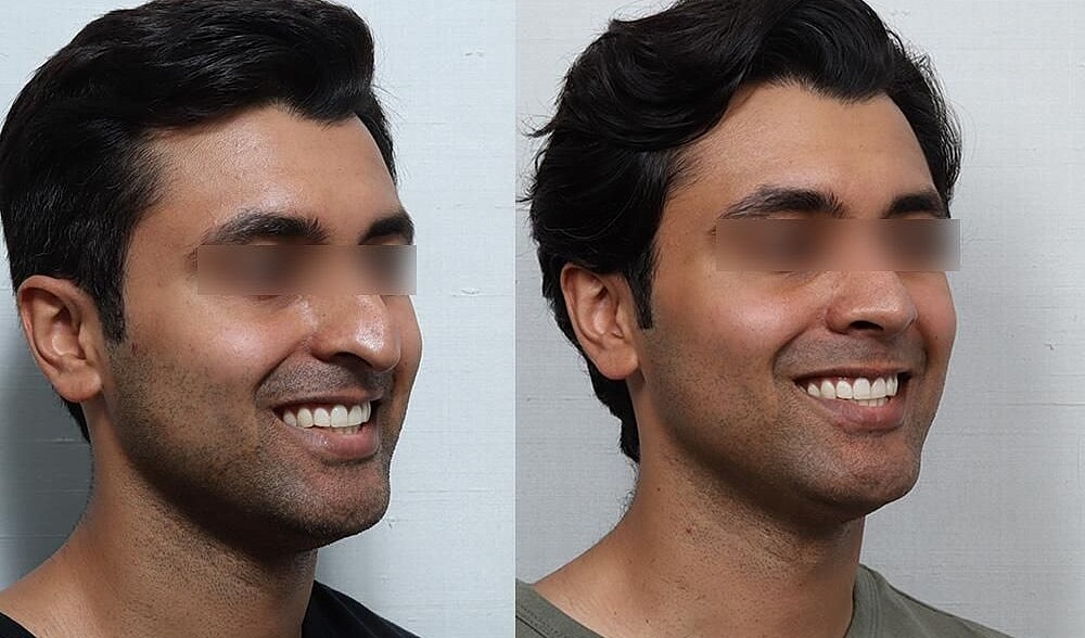 Rhinoplasty Before & After