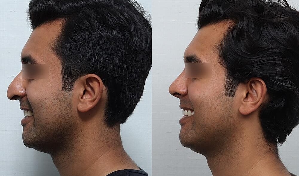 Rhinoplasty Before & After