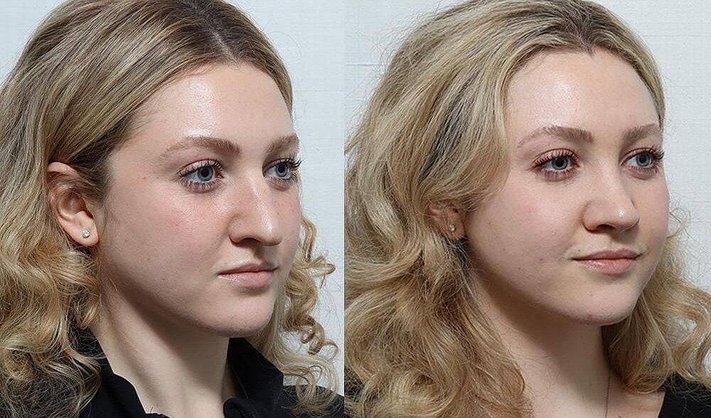 Rhinoplasty Before & After
