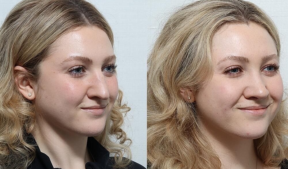 Rhinoplasty Before & After