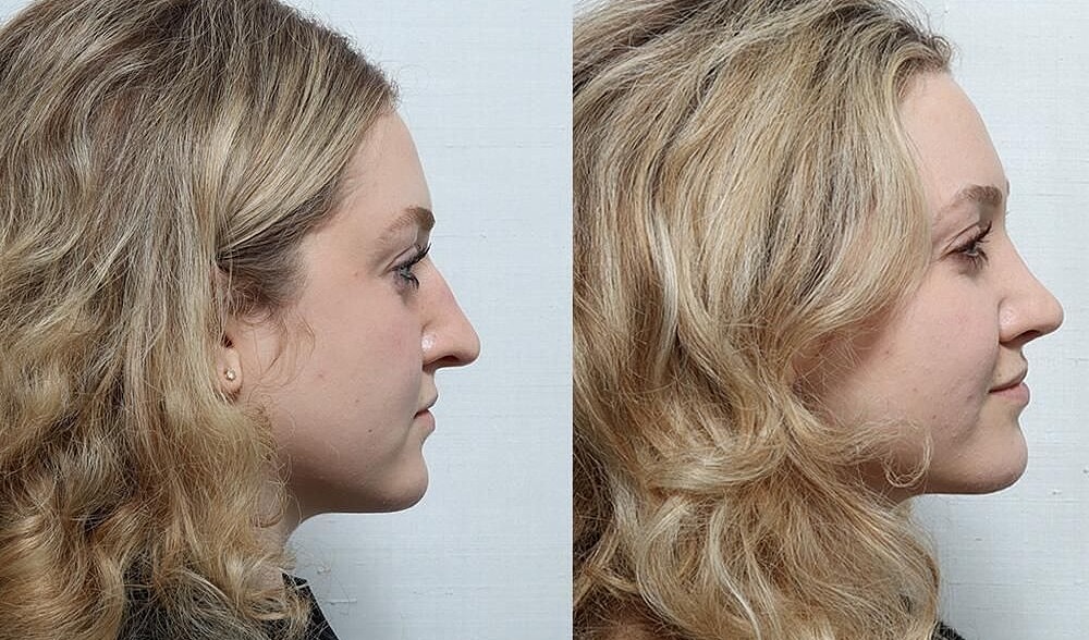 Rhinoplasty Before & After