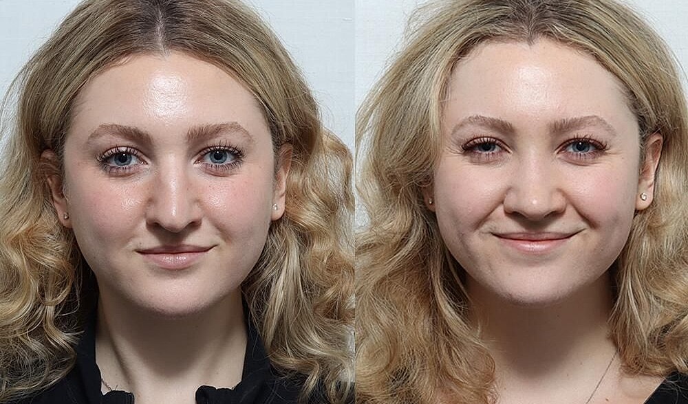 Rhinoplasty Before & After
