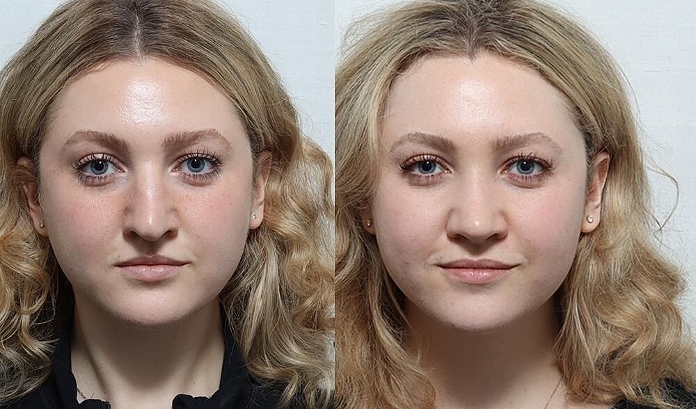 Rhinoplasty Before & After