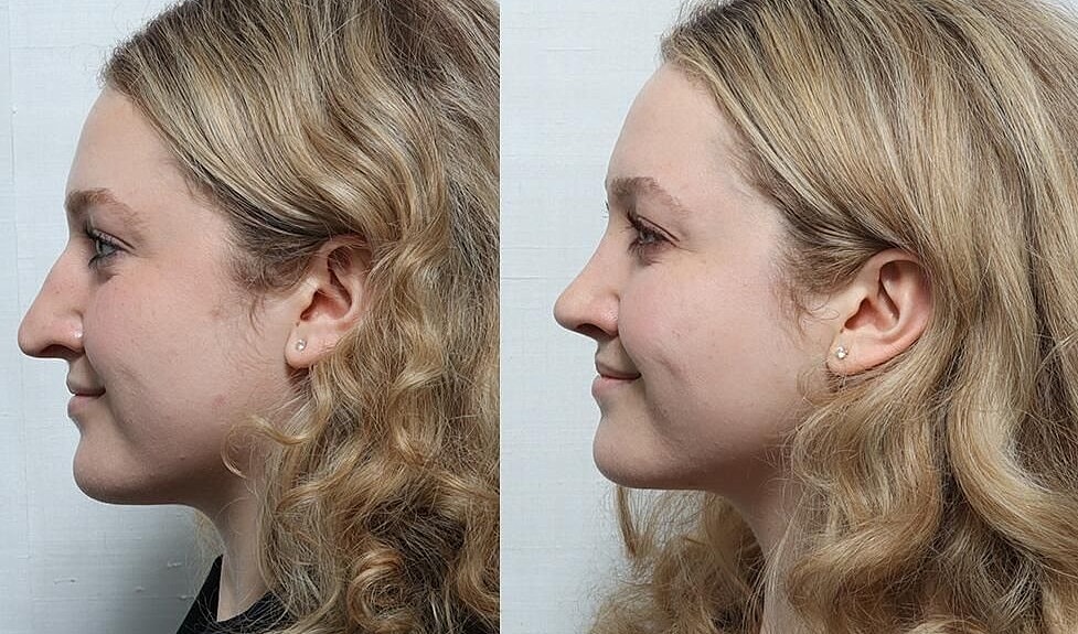Rhinoplasty Before & After