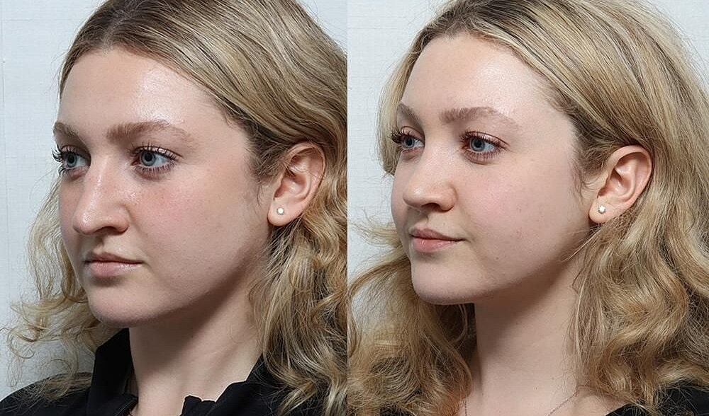 Rhinoplasty Before & After