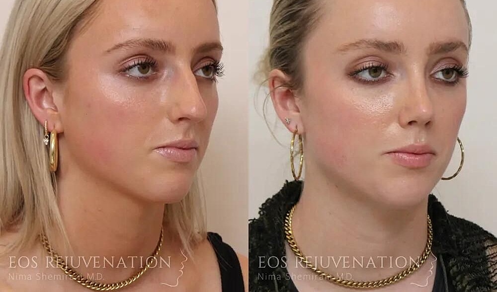 Rhinoplasty Before & After