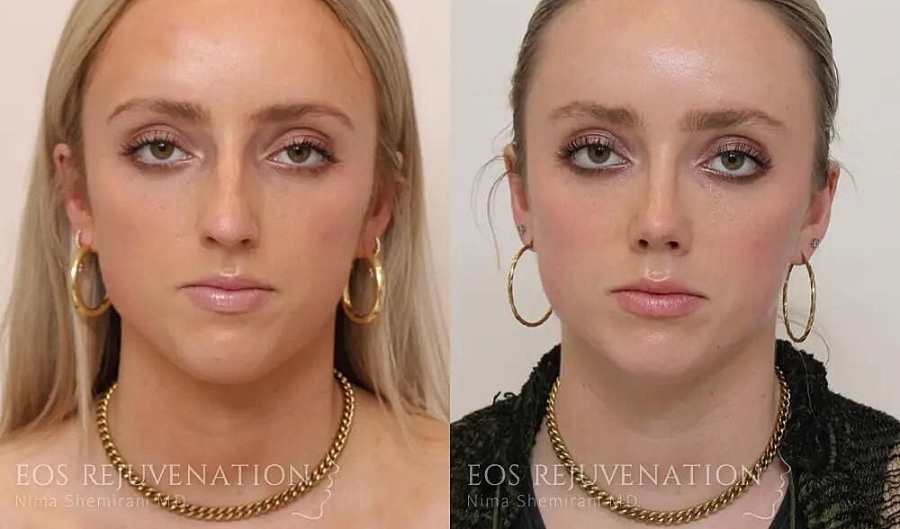 Rhinoplasty Before & After