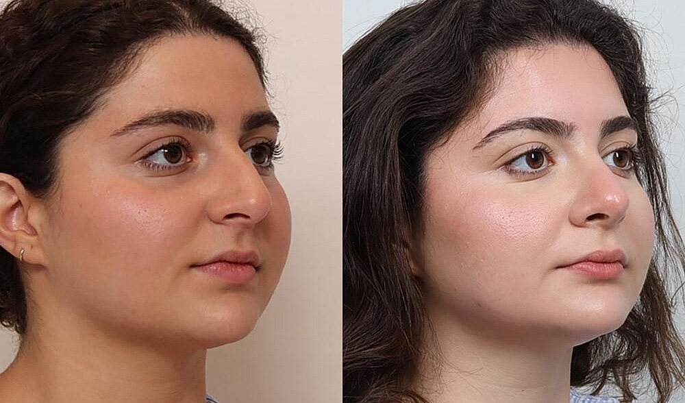Rhinoplasty Before & After