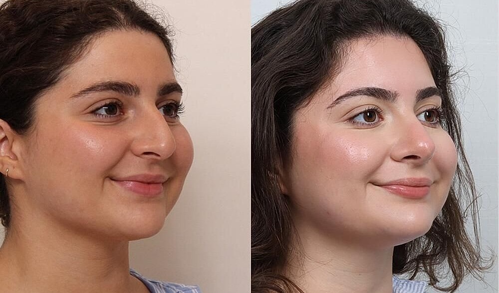 Rhinoplasty Before & After