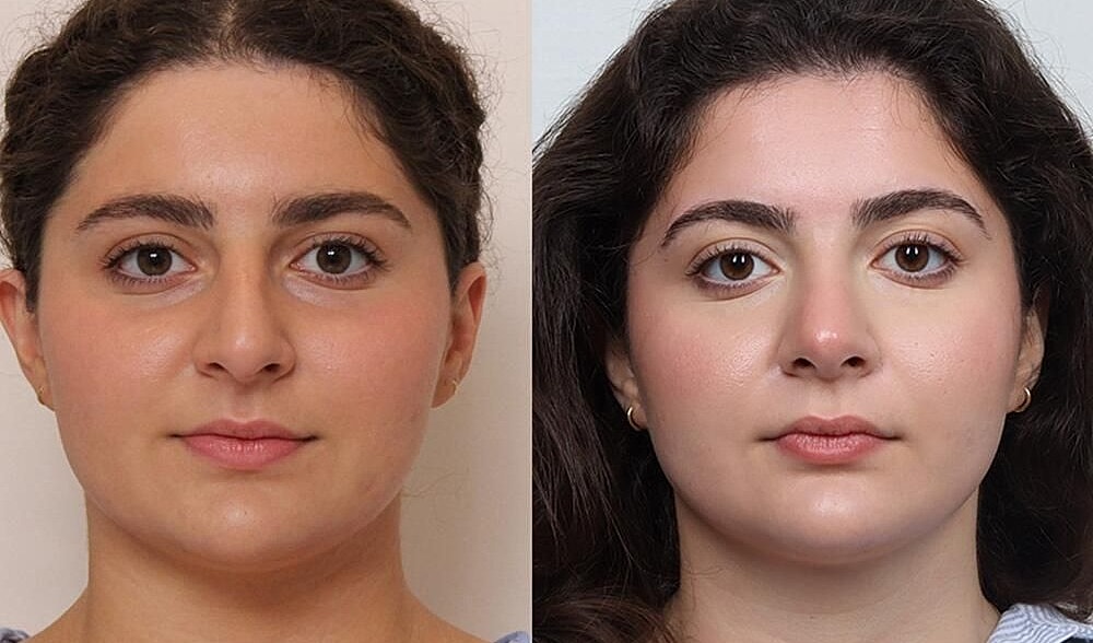 Rhinoplasty Before & After