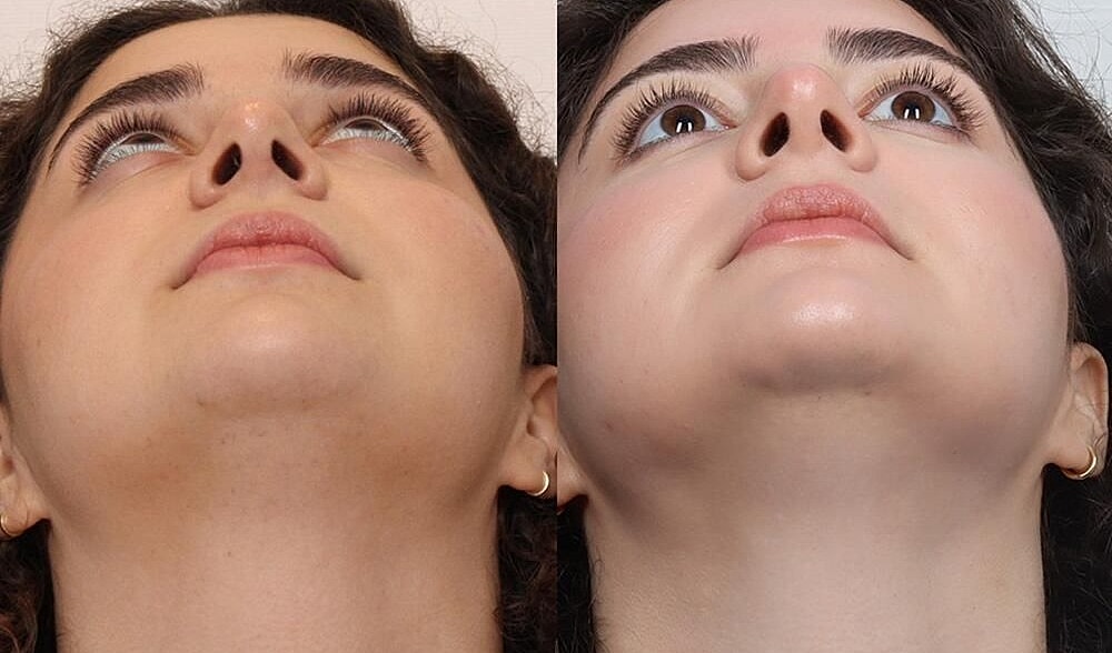 Rhinoplasty Before & After
