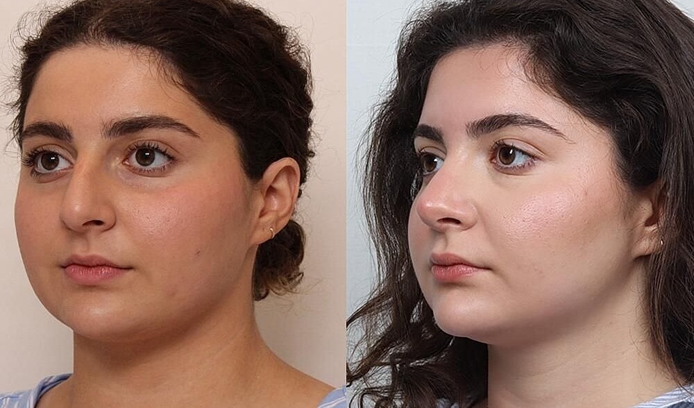 Rhinoplasty Before & After
