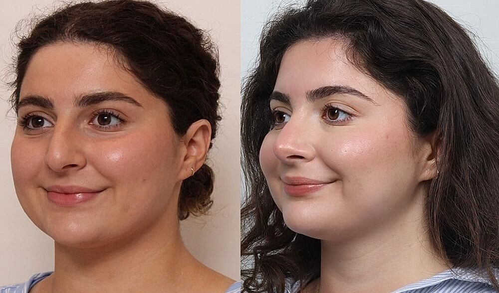 Rhinoplasty Before & After