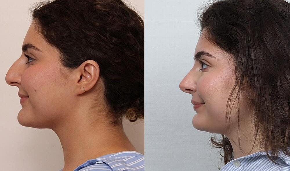 Rhinoplasty Before & After