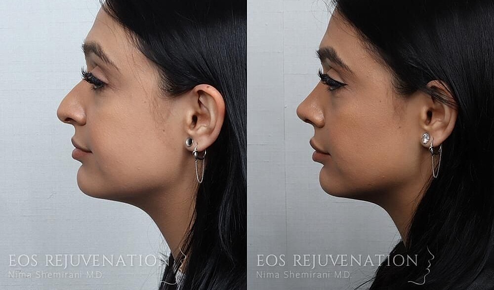 Rhinoplasty Before & After