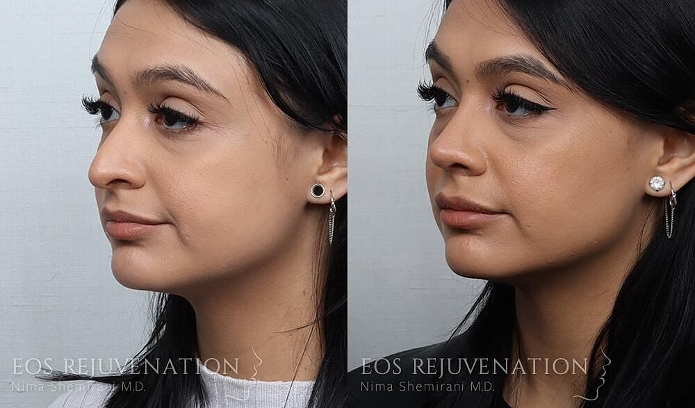 Rhinoplasty Before & After