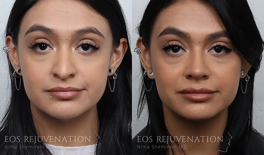 Rhinoplasty Before & After
