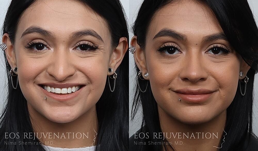 Rhinoplasty Before & After