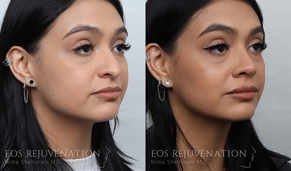 Rhinoplasty Before & After