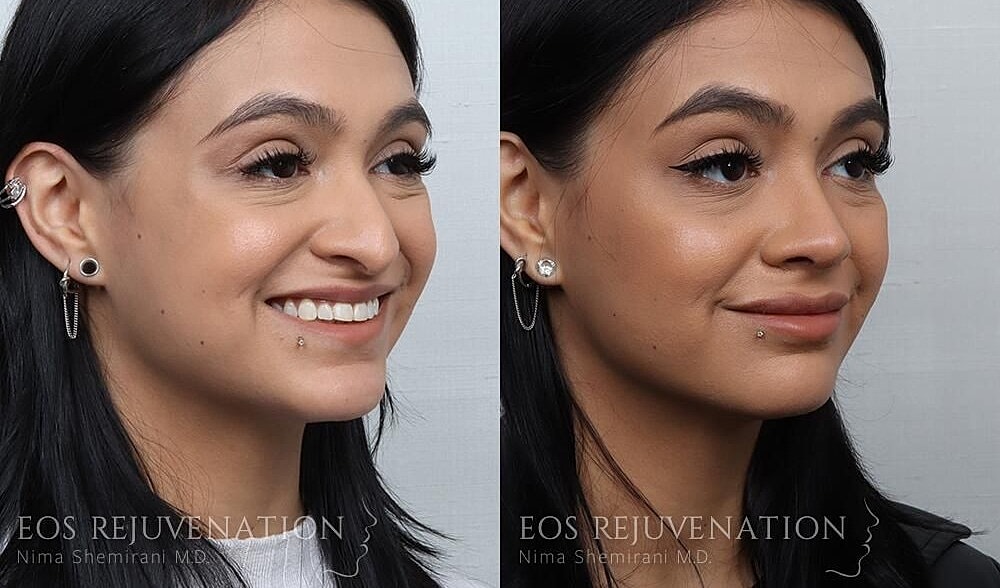Rhinoplasty Before & After