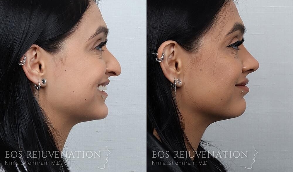 Rhinoplasty Before & After