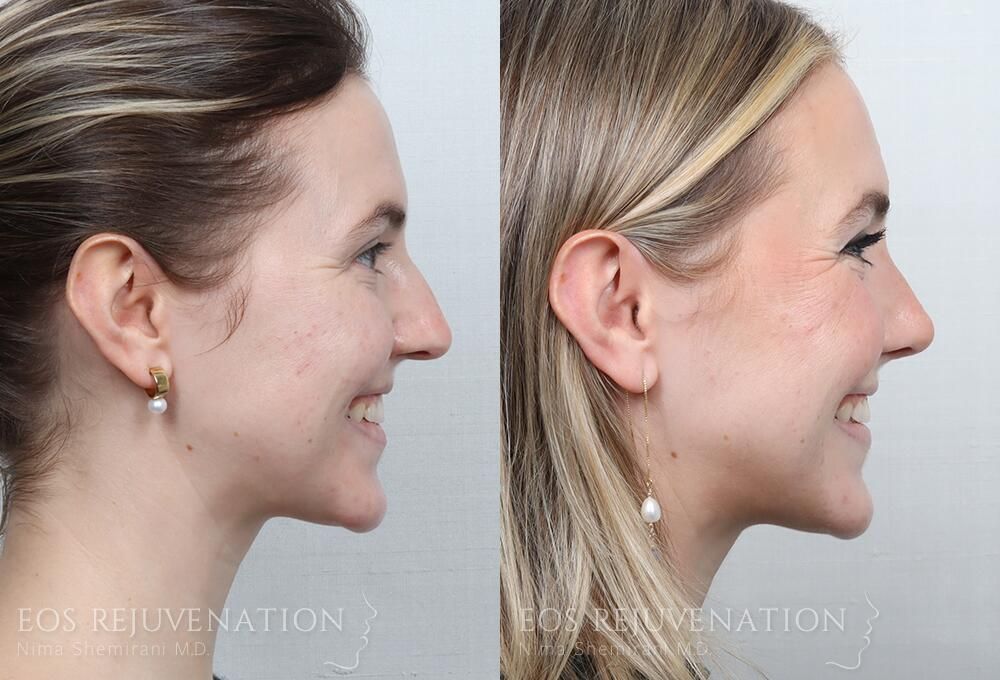 Rhinoplasty Before & After
