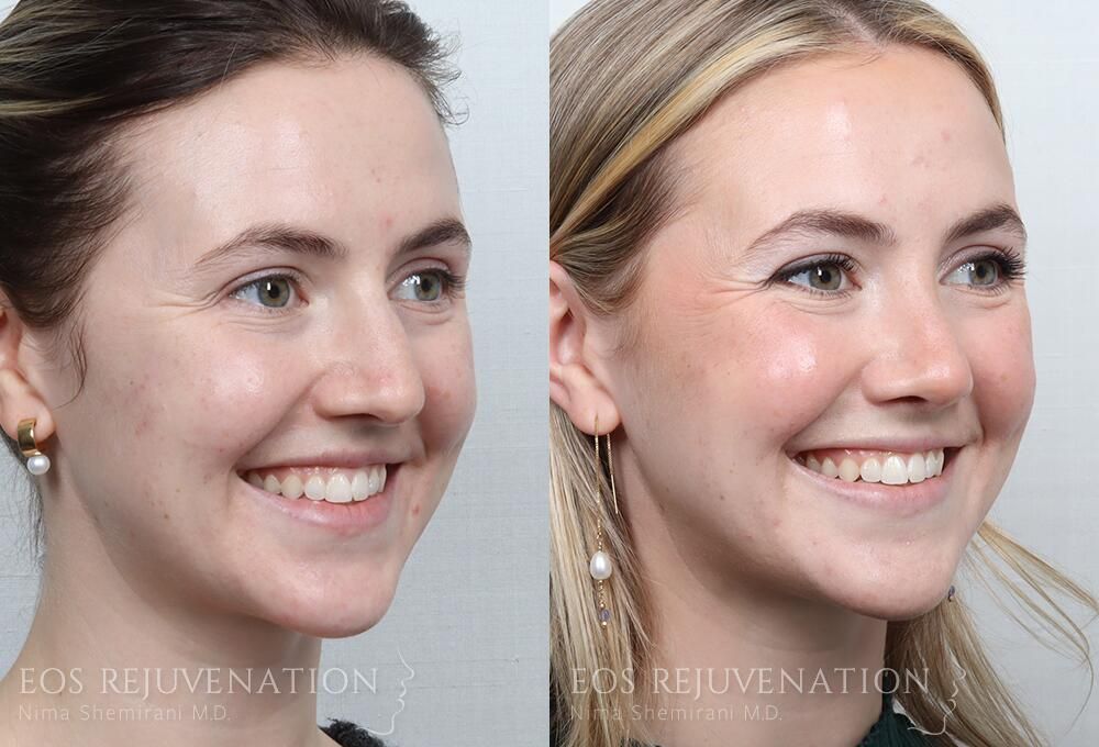 Rhinoplasty Before & After