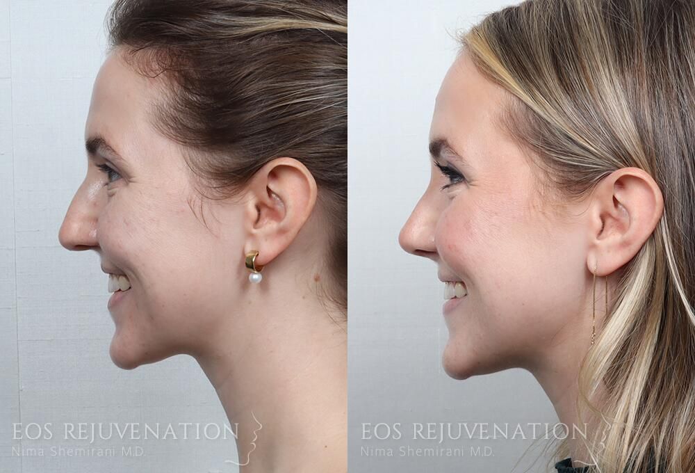 Rhinoplasty Before & After