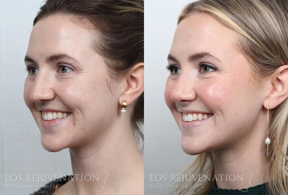 Rhinoplasty Before & After