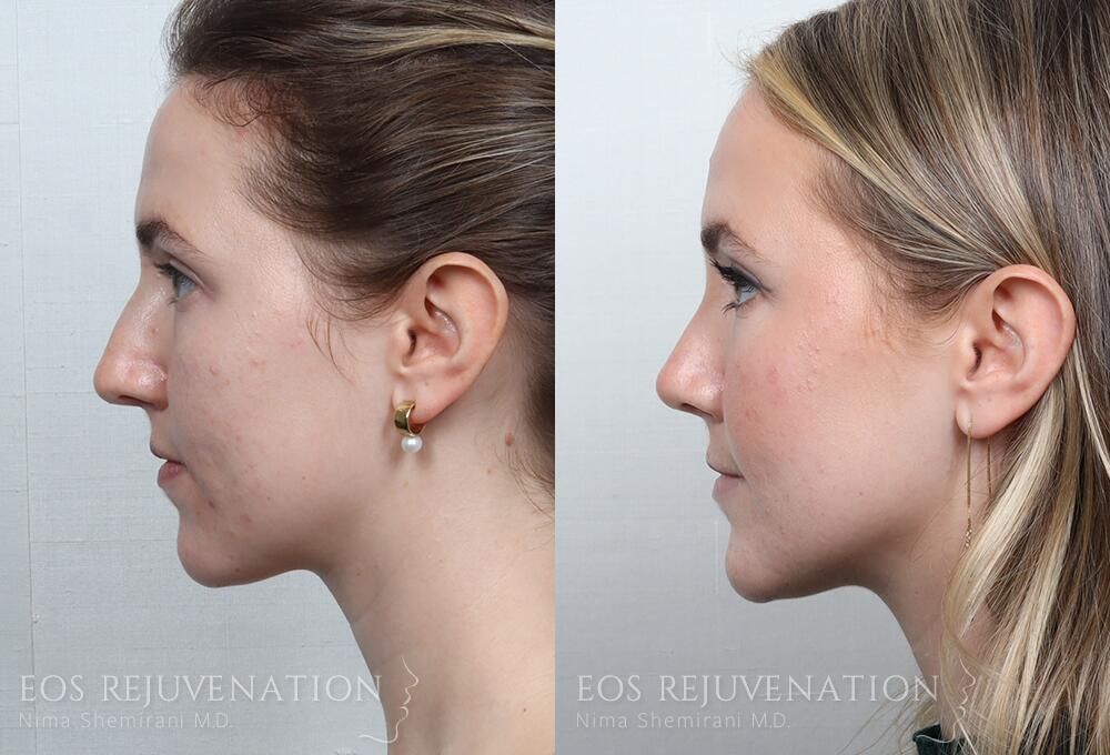Rhinoplasty Before & After