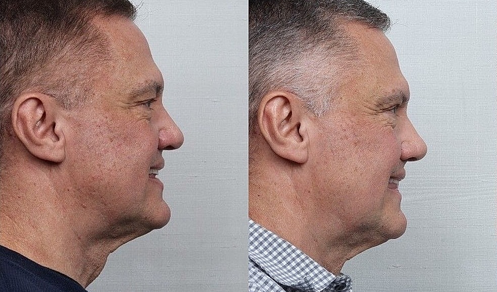 Rhinoplasty Before & After