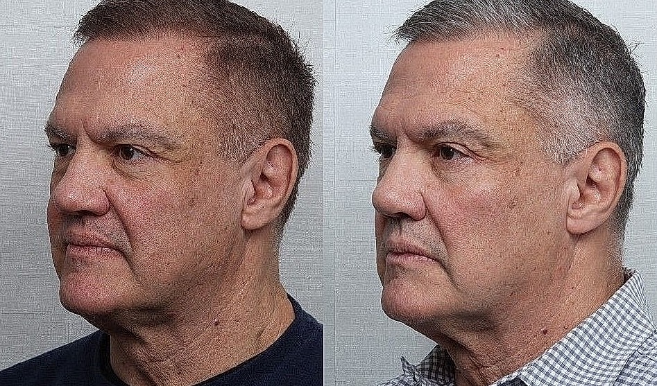 Rhinoplasty Before & After