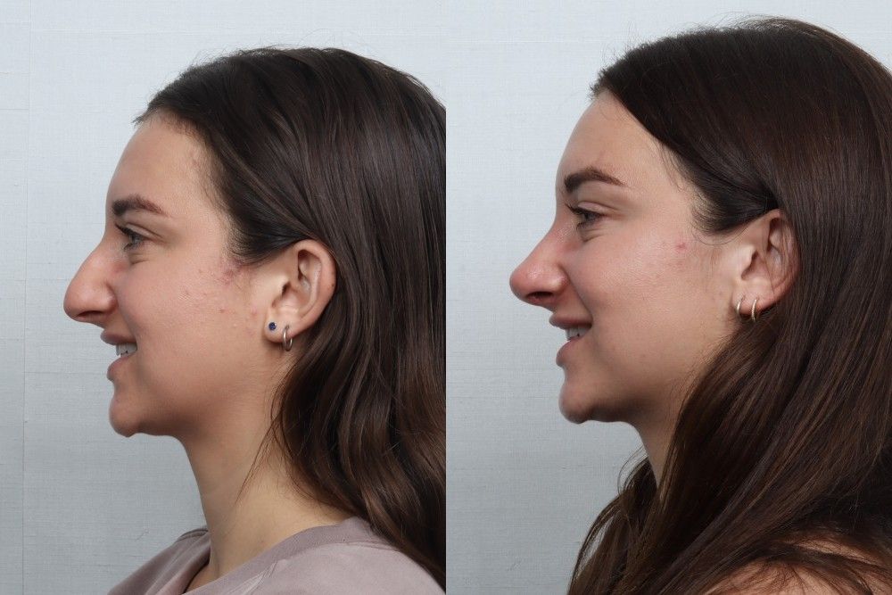 Rhinoplasty Before & After