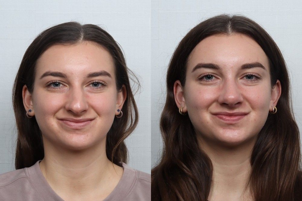 Rhinoplasty Before & After