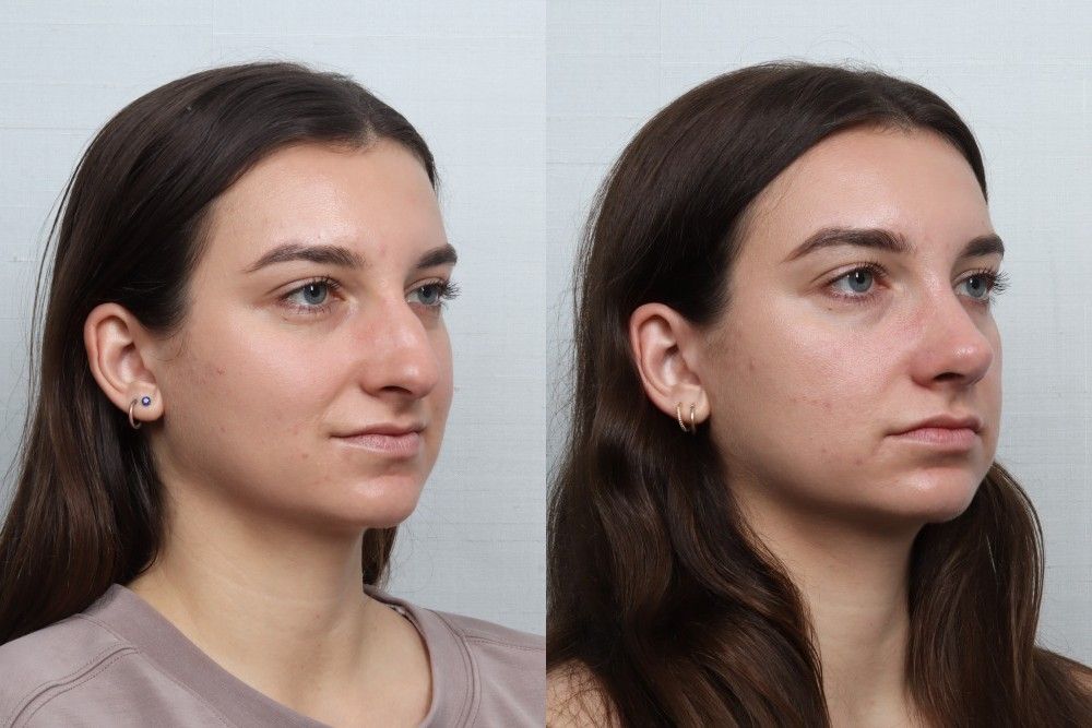 Rhinoplasty Before & After