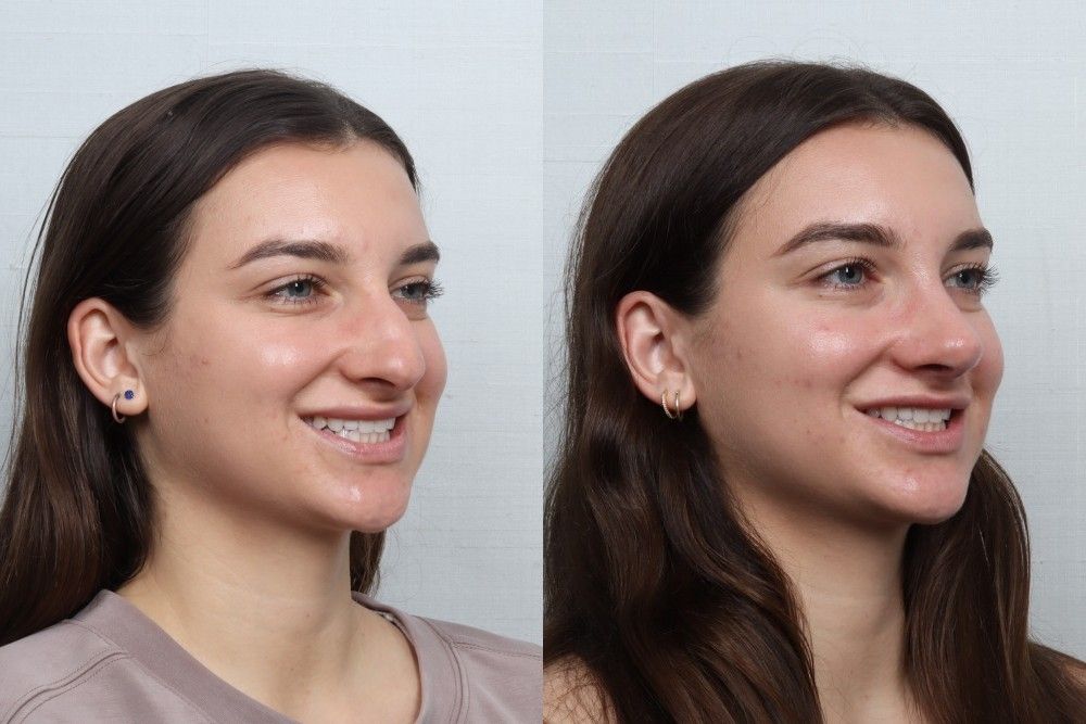 Rhinoplasty Before & After
