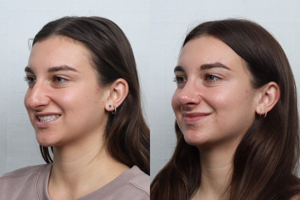 Rhinoplasty Before & After