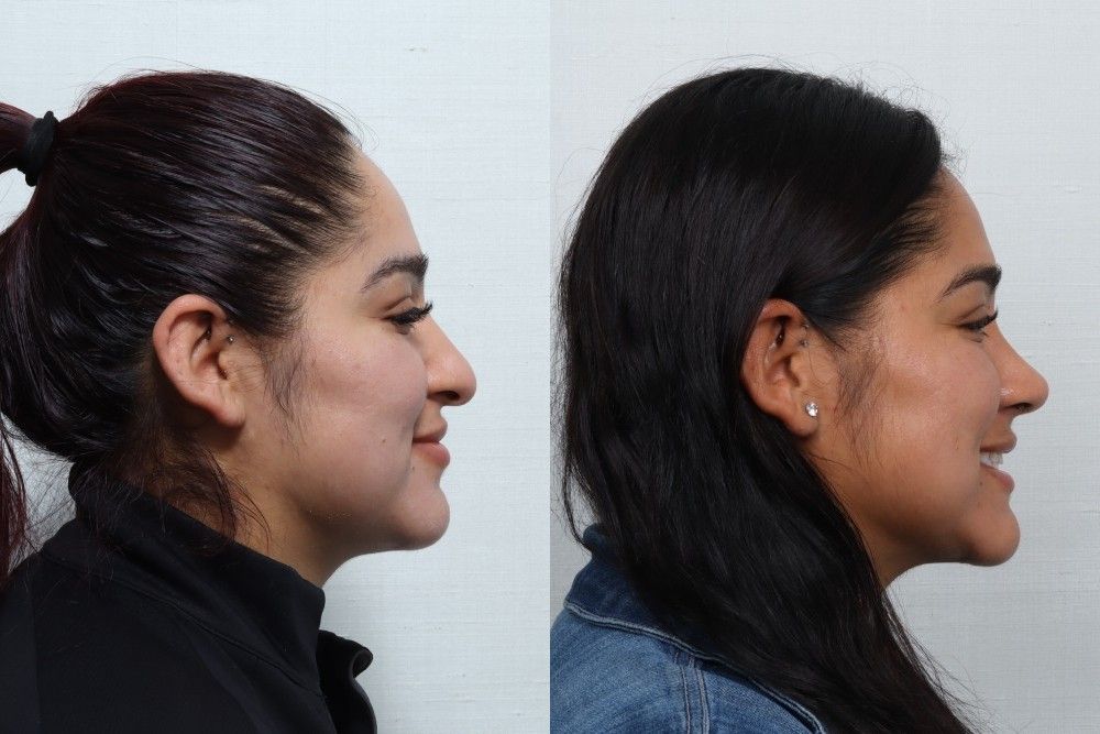 Rhinoplasty Before & After