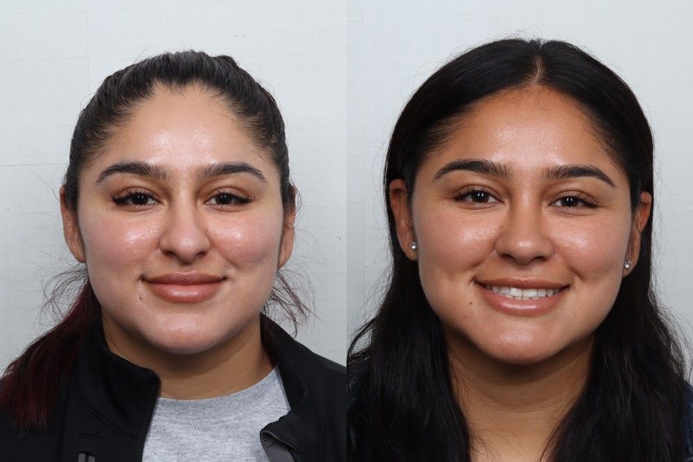 Rhinoplasty Before & After